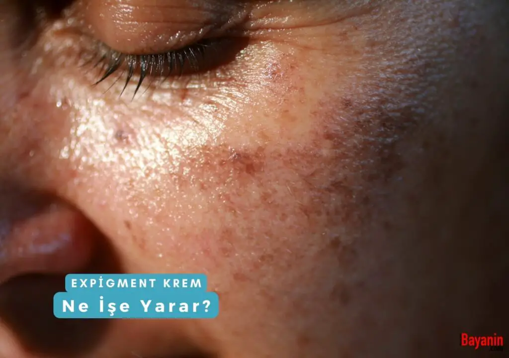 Expigment Krem Ne İşe Yarar